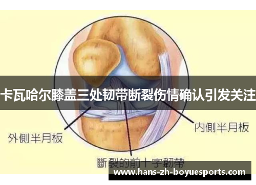 卡瓦哈尔膝盖三处韧带断裂伤情确认引发关注 卡瓦哈尔膝盖三处韧带断裂伤情确认引发关注